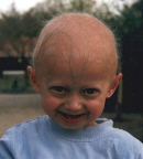 Progeria symptomen